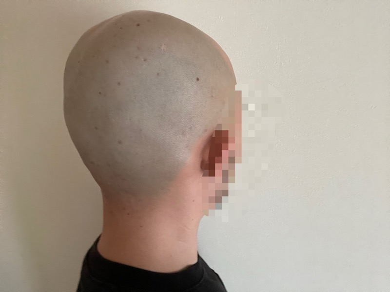 シックハイドロプロで逆剃りしたときの頭