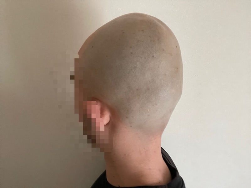 シックハイドロプロで逆剃りしたときの頭