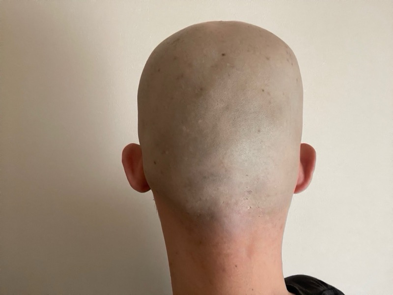 シックハイドロプロで逆剃りしたときの頭