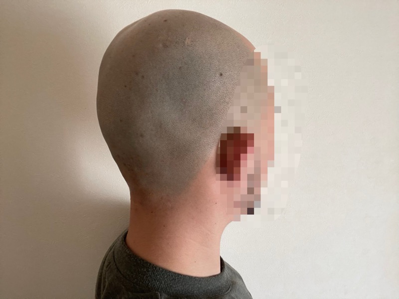 シックハイドロプロで順剃りしたときの頭