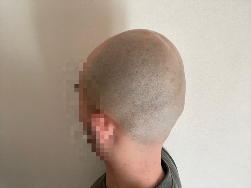 シックハイドロプロで順剃りしたときの頭