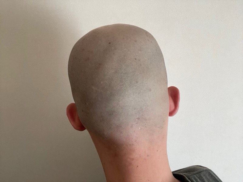 シックハイドロプロで順剃りしたときの頭